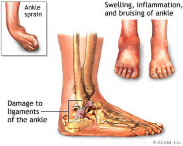 Naturally Healing the Most Common Ankle Sprain