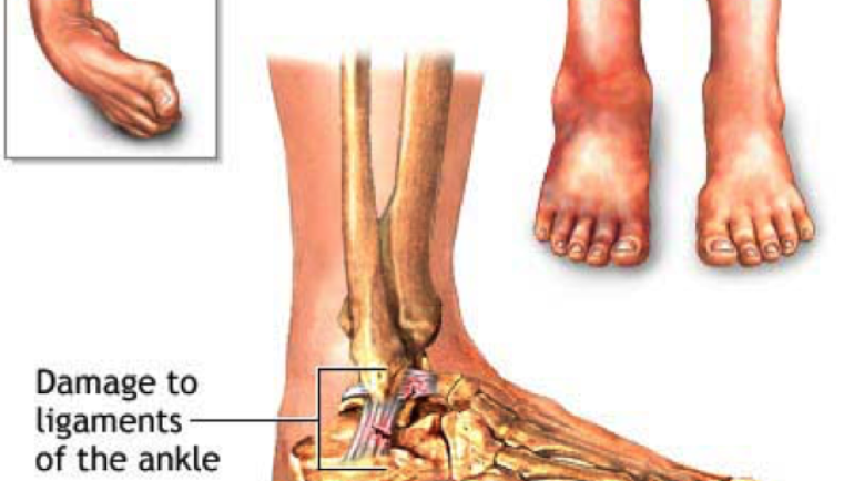 Naturally Healing the Most Common Ankle Sprain