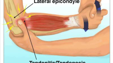Elbow Pain Due to Repetitive Movements