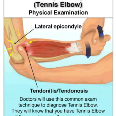 Elbow Pain Due to Repetitive Movements