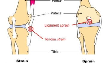 Do You Have A Strain vs. Sprain?