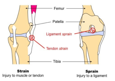 Do You Have A Strain vs. Sprain?