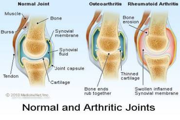 Important Facts about Arthiritis