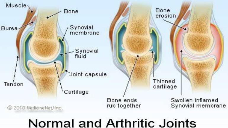 Important Facts about Arthiritis