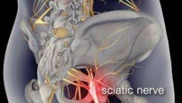 Treating Low Back Pain and Sciatica Naturally