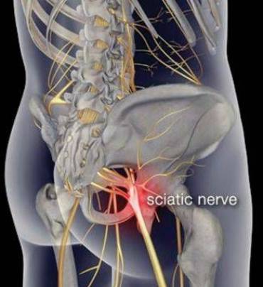 Treating Low Back Pain and Sciatica Naturally